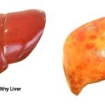 Fatty liver , so common now