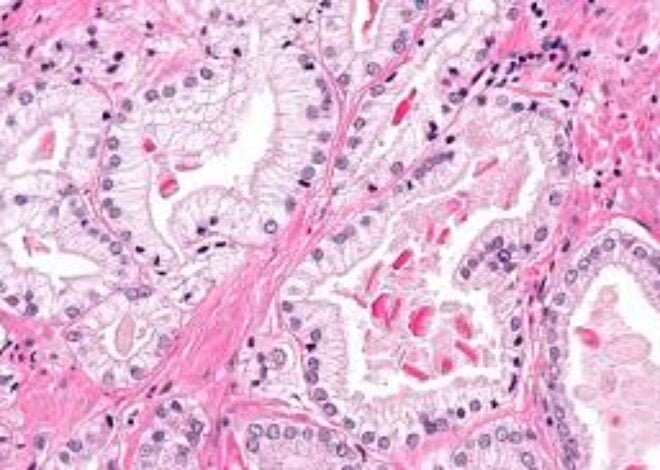 Has my prostate been enlarged? If so, what next? Middle aged men need to know.