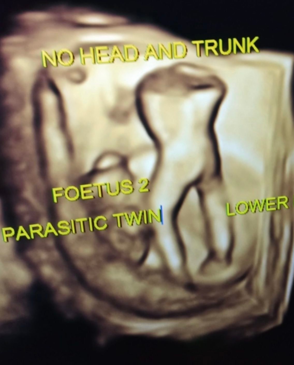 Image of the month : Parasitic Twin , a  rare ultrasound diagnosis