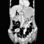 Case of the month : Where did the Gallstones go?