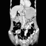 Case of the month : Where did the Gallstones go?