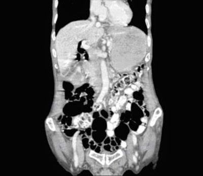 Case of the month : Where did the Gallstones go?