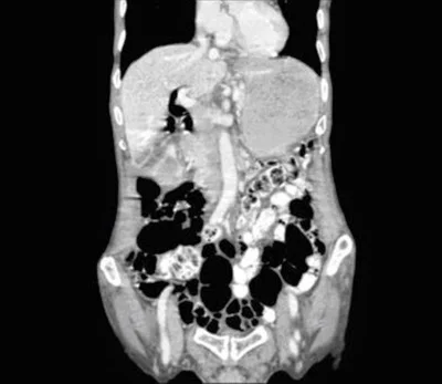 Case of the month : Where did the Gallstones go?